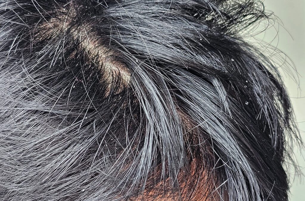 Seboroični dermatitis kod beba