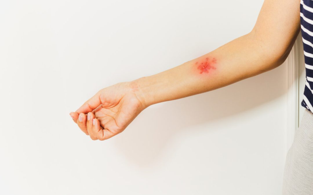 Herpes simplex na tijelu (HSV-1 i HSV-2)