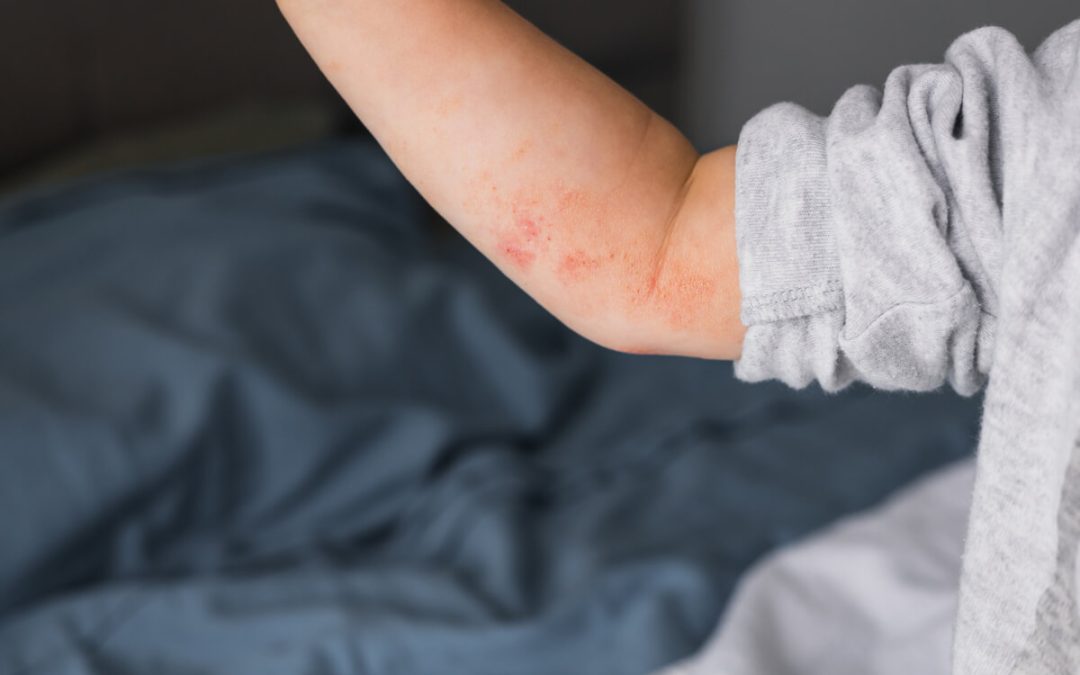 Kada se javlja atopijski dermatitis i tko je u riziku?
