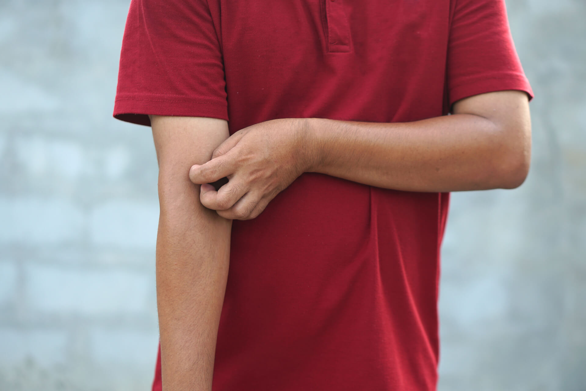 Kako prepoznati svrab (1)