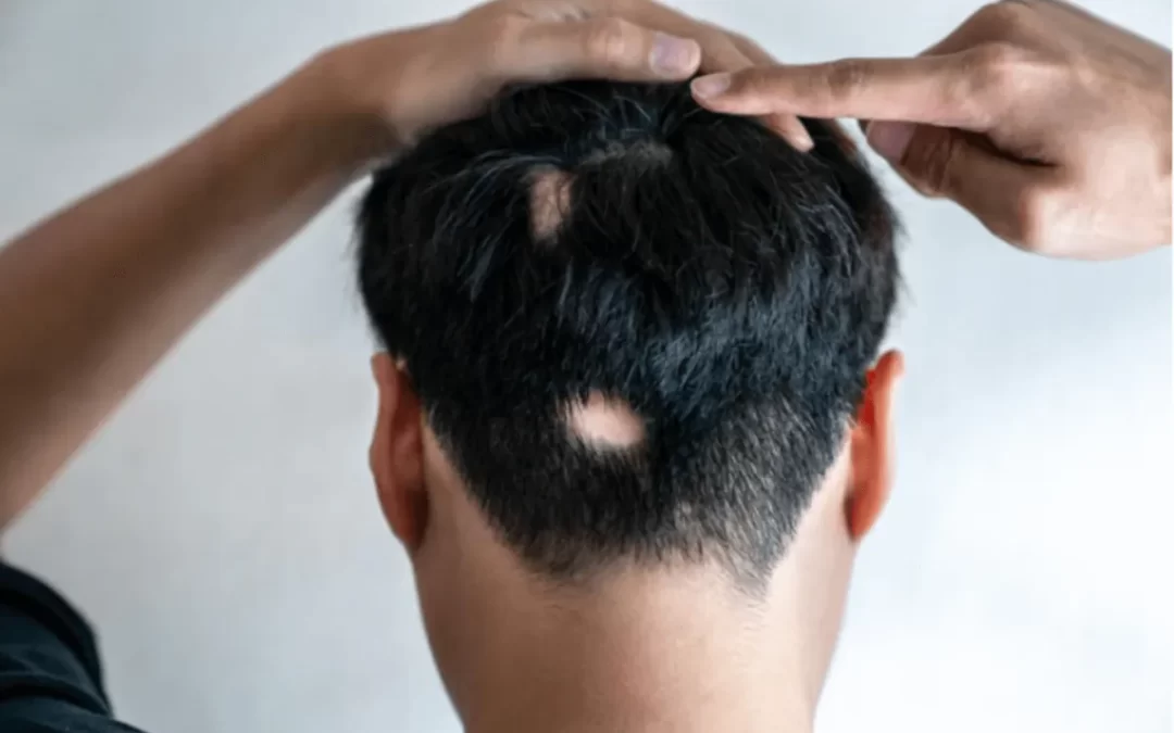 Alopecija kod žena – kada gubitak kose postaje više od estetskog problema