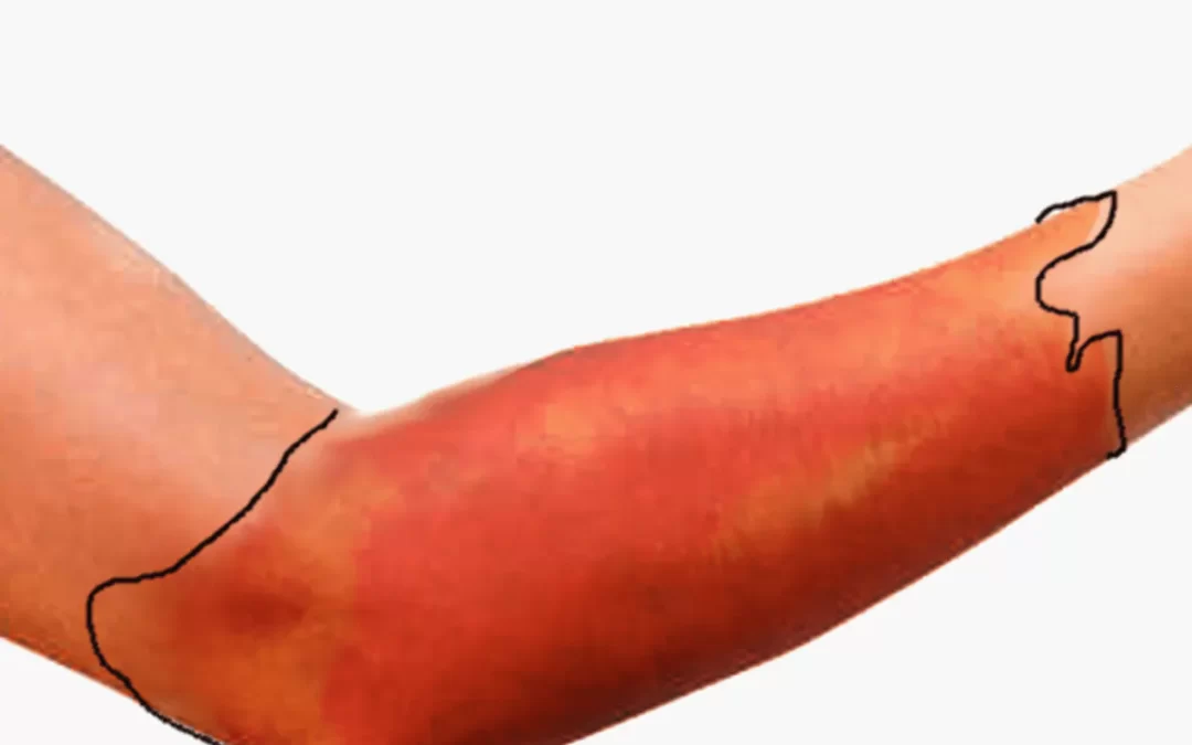 Tko ima povećan rizik od razvoja crvenog vjetra i zašto je prevencija jednako važna kao i liječenje